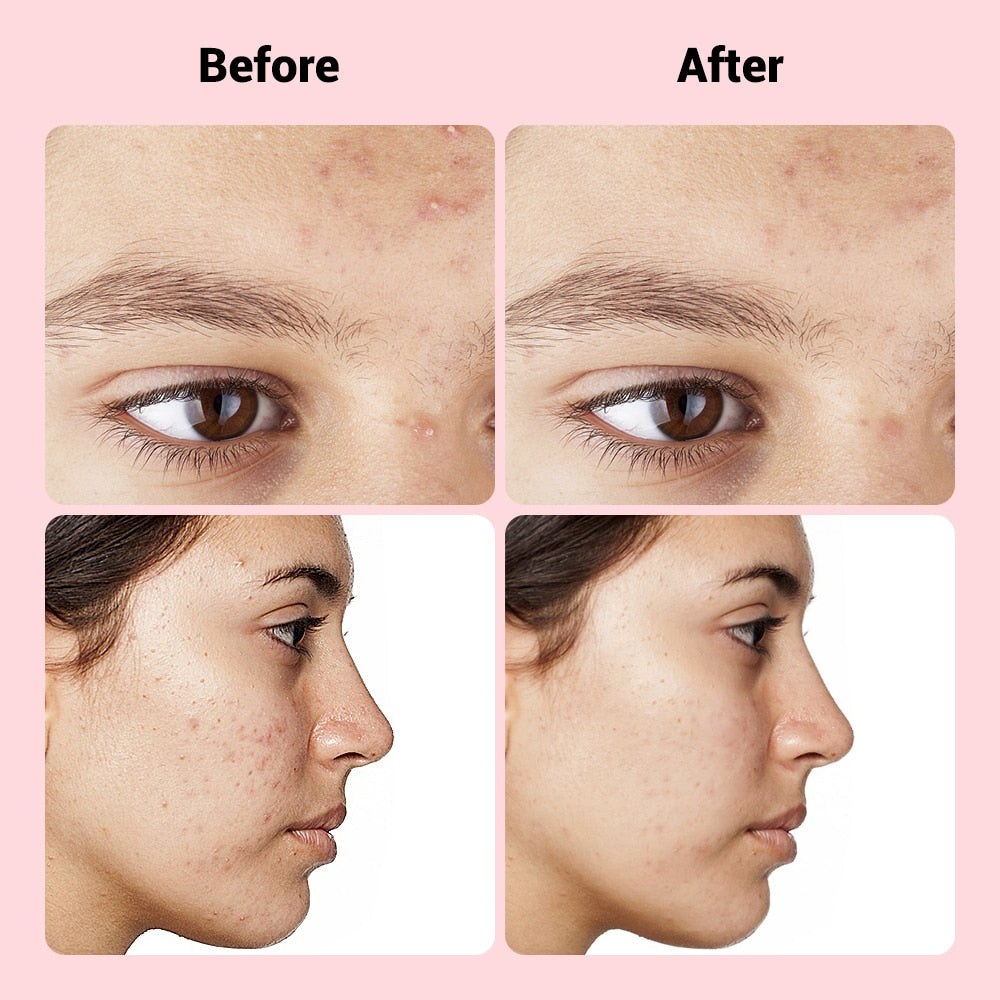 Before and after comparison photos showing skin improvement from acne and blemishes.