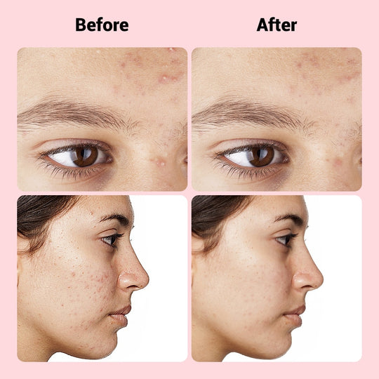 Before and after comparison photos showing skin improvement from acne and blemishes.