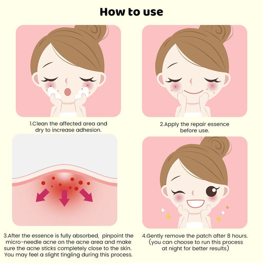 Four-step instructional guide on how to use micro-needle acne patches for skin repair.
